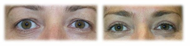 Bleph Upper43 Eyelid Surgery: Upper lid blepharoplasty