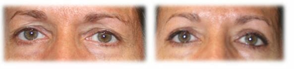 Eyelid Surgery: Upper lid blepharoplasty