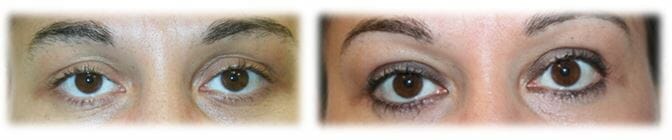 Eyelid Surgery: Upper lid blepharoplasty