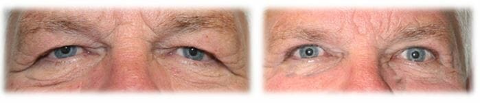 Eyelid Surgery: Upper lid blepharoplasty