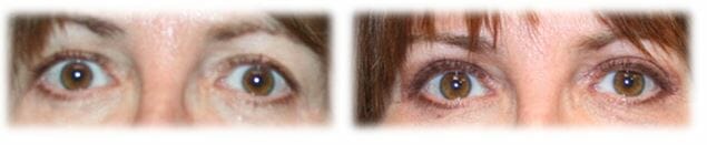 Bleph Upper47 Eyelid Surgery: Upper lid blepharoplasty