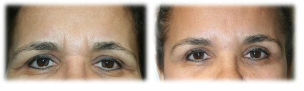 Eyelid Surgery: Upper lid blepharoplasty