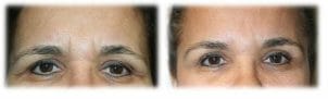Blepharoplasty before and afters