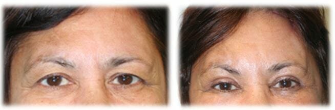 Eyelid Surgery: Upper lid blepharoplasty