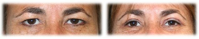 Eyelid Surgery: Upper lid blepharoplasty