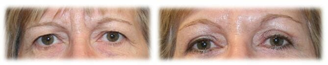 Eyelid Surgery: Upper lid blepharoplasty