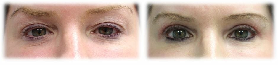 Bleph Upper51 Eyelid Surgery: Upper lid blepharoplasty