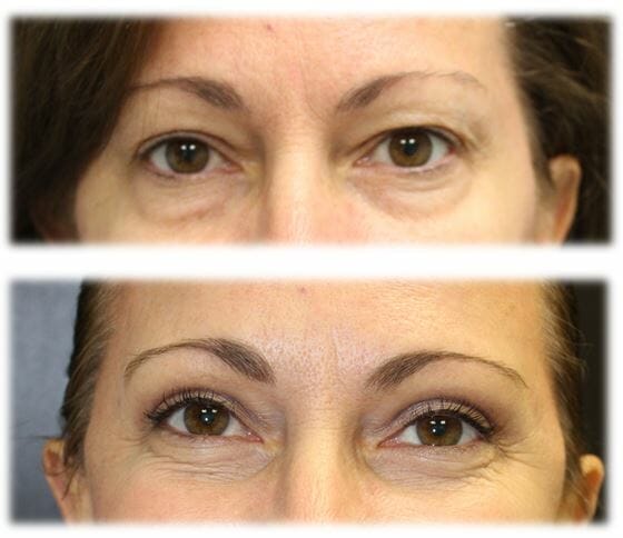 Bleph Upper52 Eyelid Surgery: Upper lid blepharoplasty