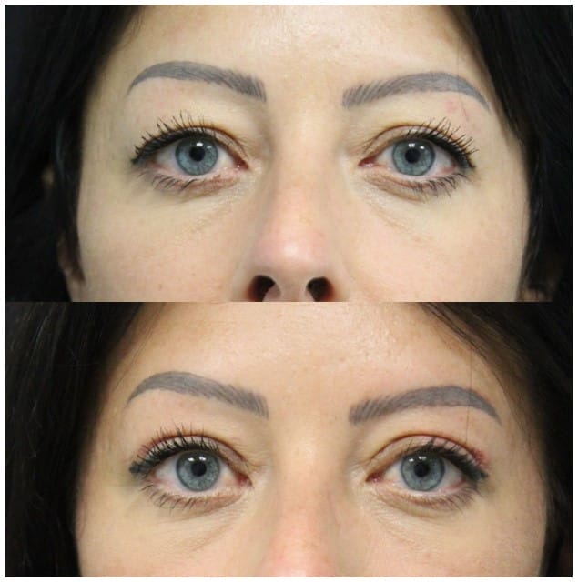 Eyelid Surgery: Upper lid blepharoplasty