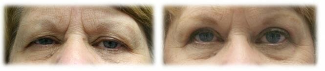 Eyelid Surgery: Upper lid blepharoplasty