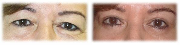 Bleph Upper7 Eyelid Surgery: Upper lid blepharoplasty
