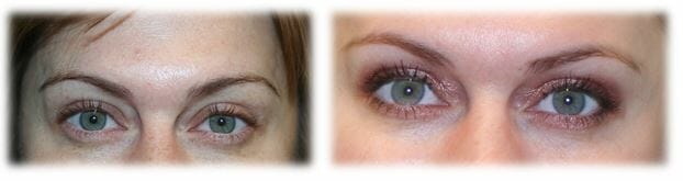 Blepharoplasty before and afters