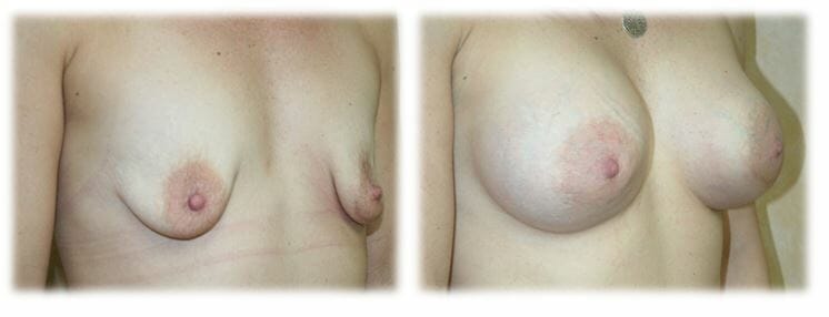 Breast Augmentation by Dr. Thomassen