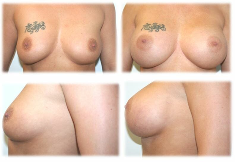Breast Augmentation by Dr. Thomassen