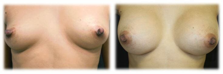 Breast Augmentation by Dr. Thomassen
