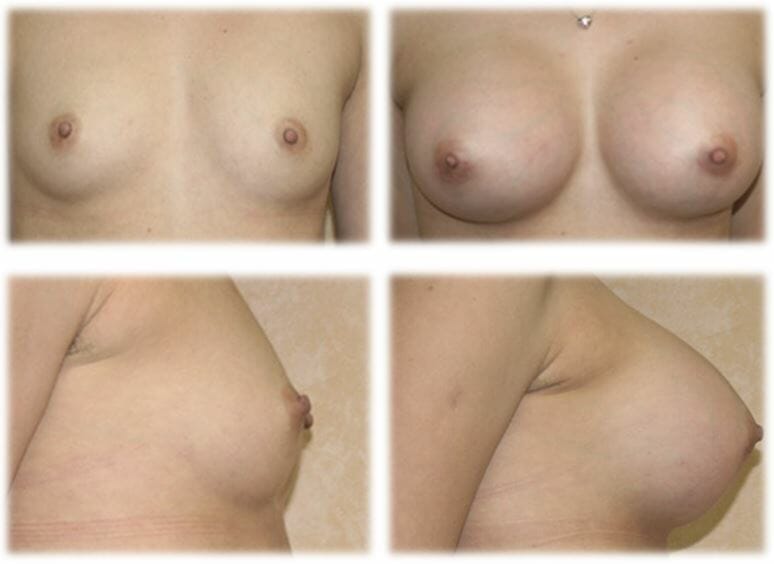 Breast Augmentation by Dr. Thomassen