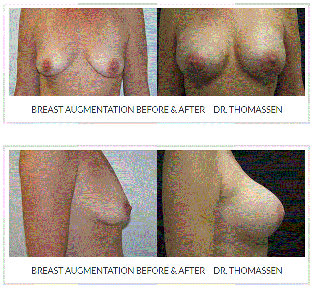 Breast Augmentation by Dr. Thomassen