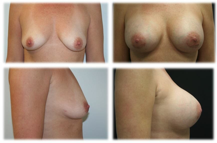 Breast Augmentation by Dr. Thomassen