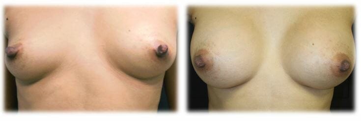 Breast Augmentation by Dr. Thomassen