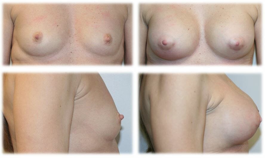 Breast Augmentation by Dr. Thomassen