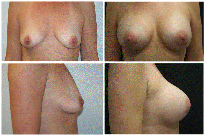 Breast Augmentation by Dr. Thomassen