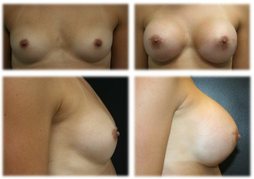 Breast Augmentation by Dr. Thomassen