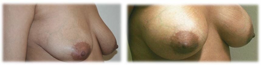 Breast Augmentation by Dr. Thomassen
