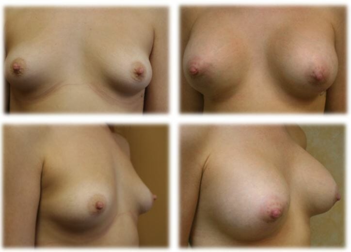 Breast Augmentation by Dr. Thomassen