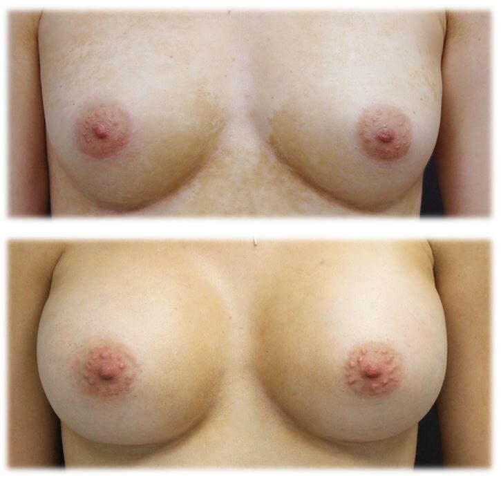 Breast Augmentation by Dr. Thomassen