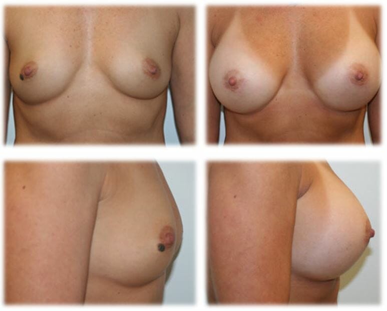Breast Augmentation by Dr. Thomassen