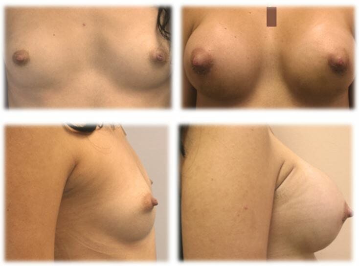 Breast Augmentation by Dr. Thomassen