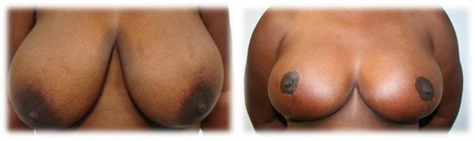 Breast Reduction by Dr. Thomassen