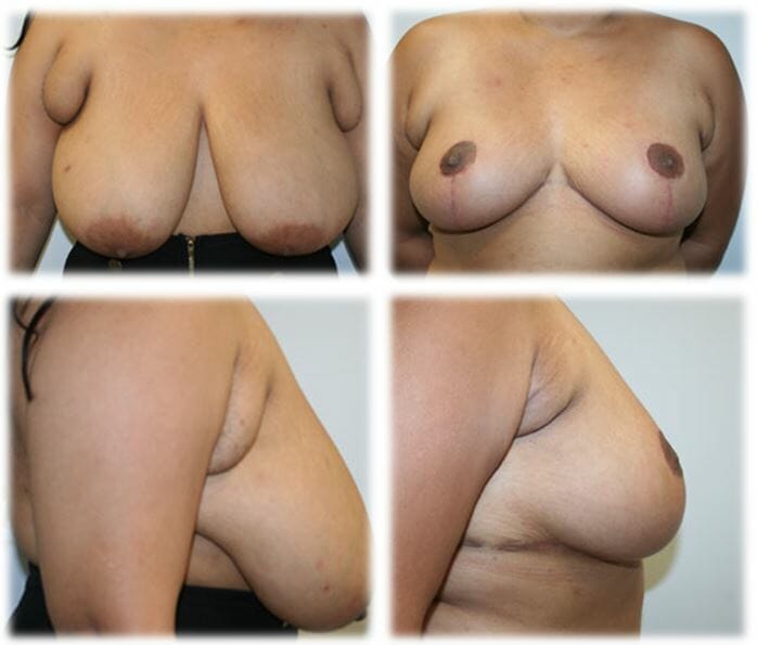 Breast Reduction by Dr. Thomassen