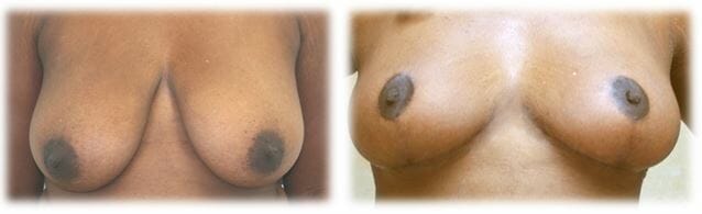 Breast Reduction by Dr. Thomassen