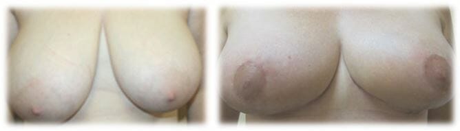 Breast Reduction by Dr. Thomassen