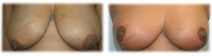Breast Reduction by Dr. Thomassen
