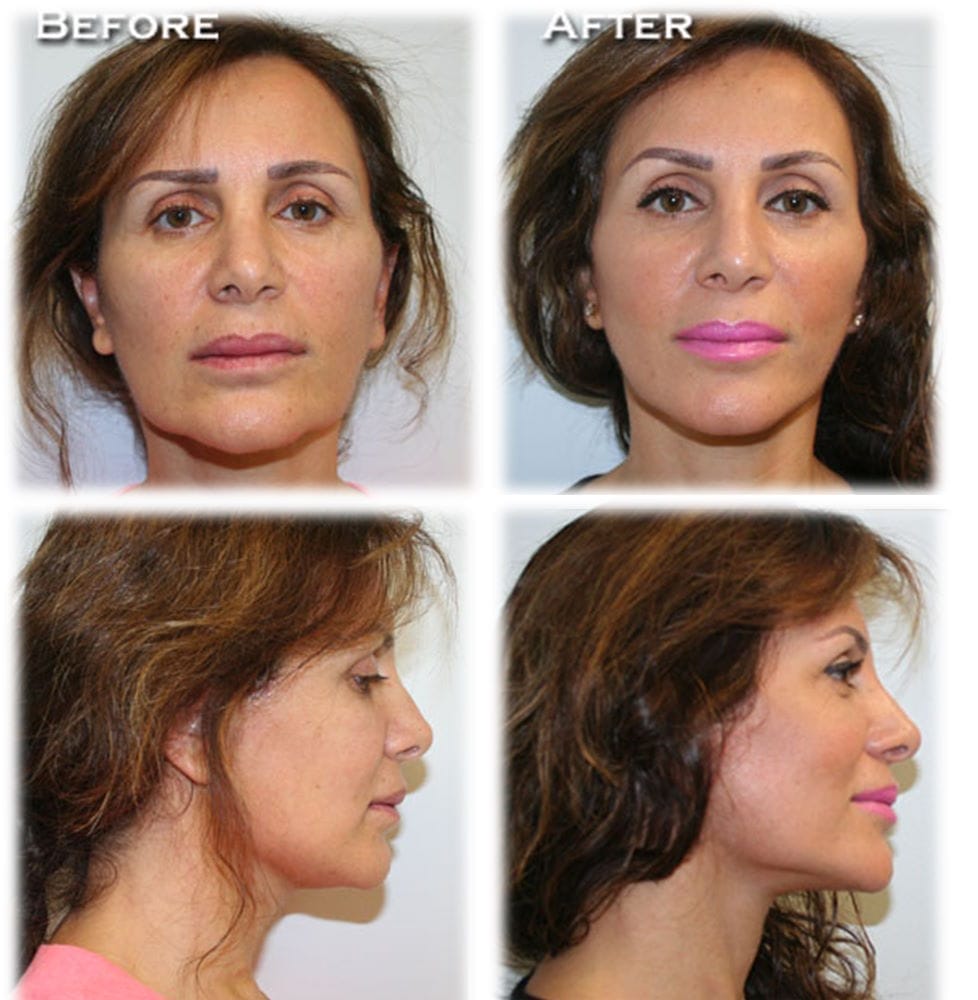 Dr. Thomassen Facelift Fort Lauderdale