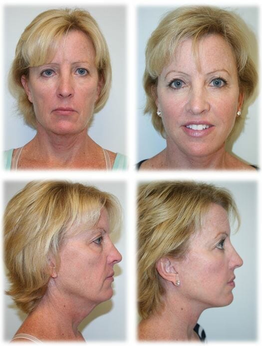 Facelift in Fort Lauderdale by Dr. Thomassen