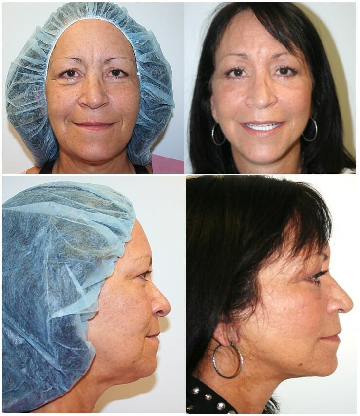facelift before and after fort lauderdale
