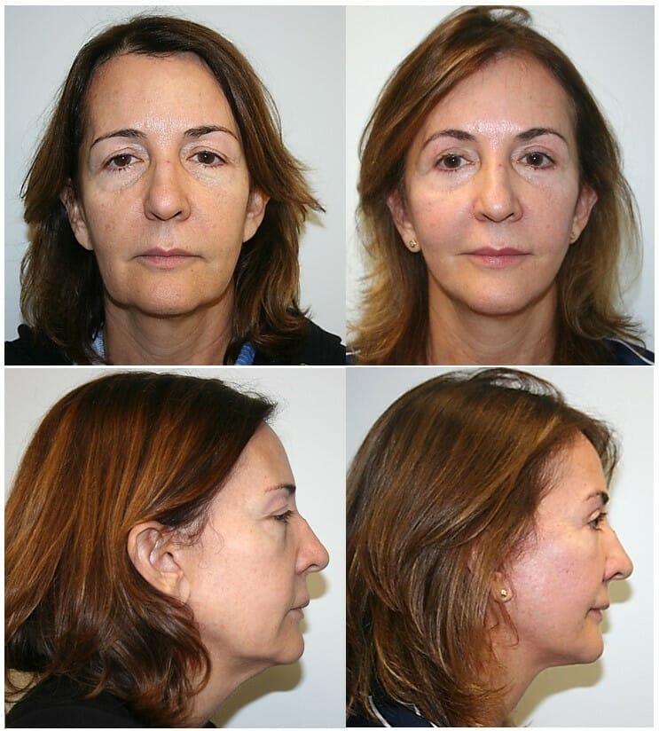 Facelift in Fort Lauderdale by Dr. Thomassen