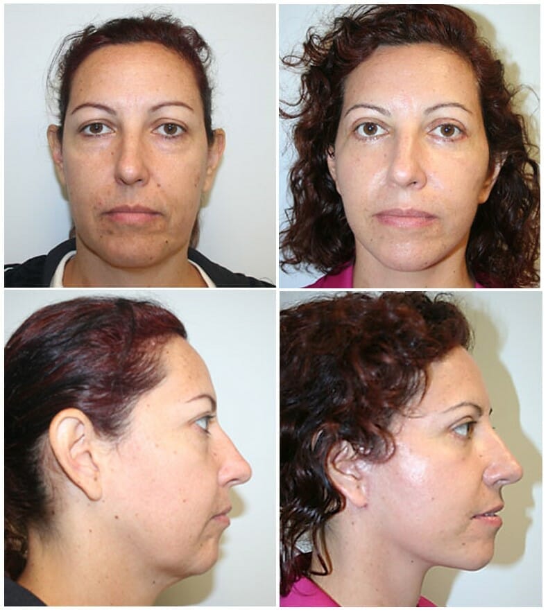 facelift before and after fort lauderdale