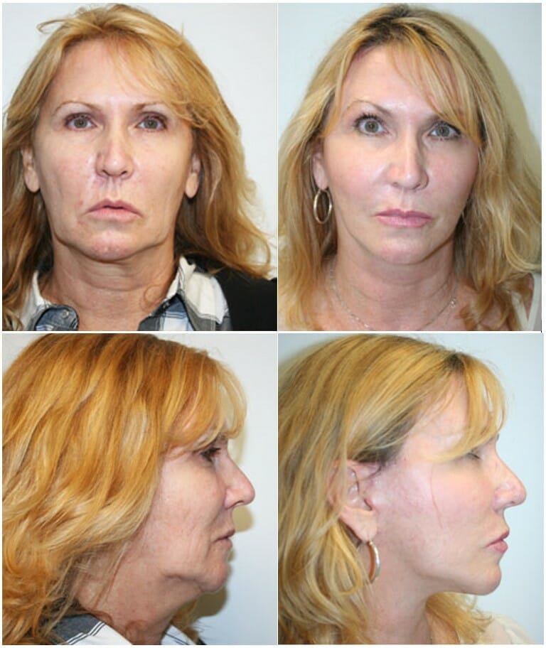 facelift before and after fort lauderdale