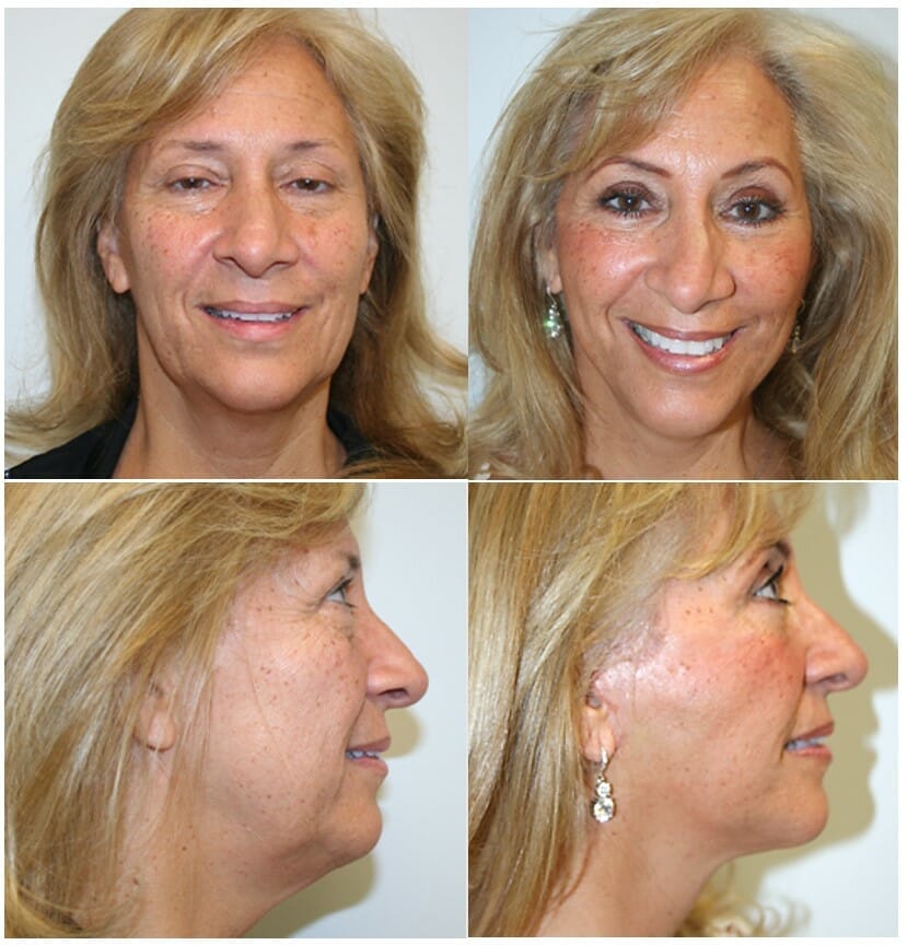 facelift before and after fort lauderdale