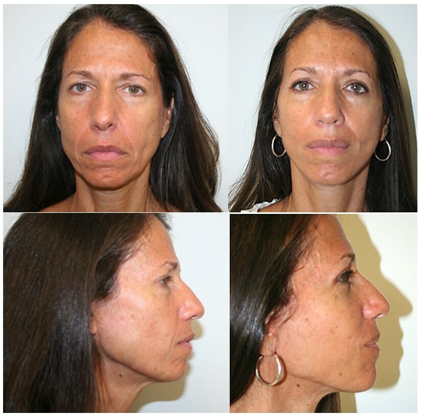 facelift before and after fort lauderdale