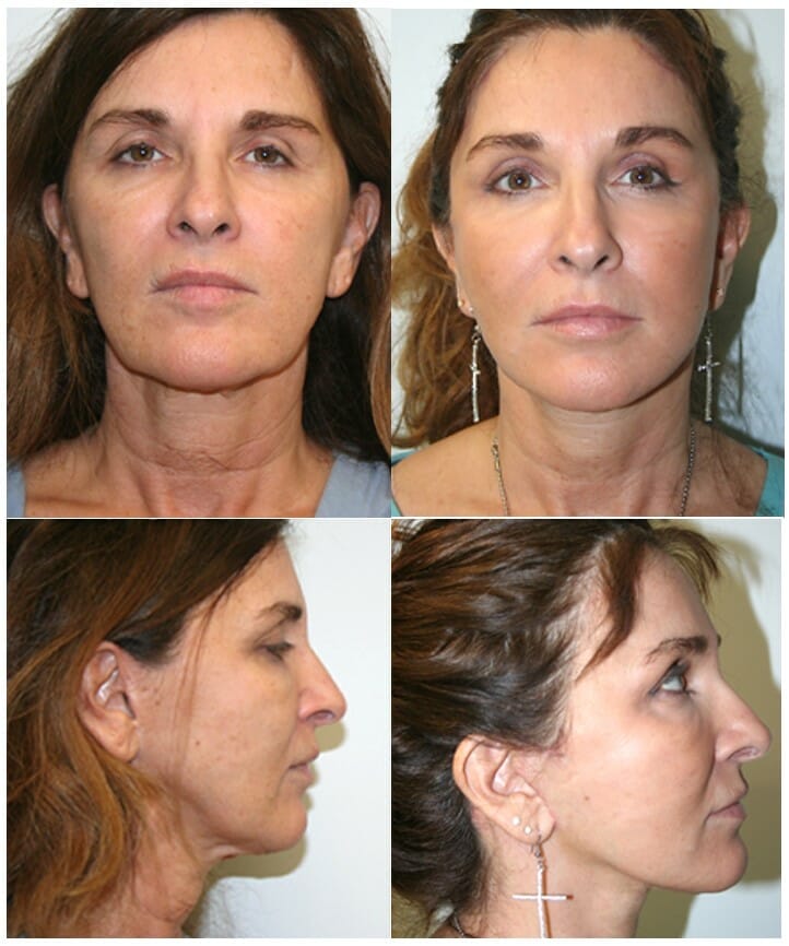 facelift before and after fort lauderdale