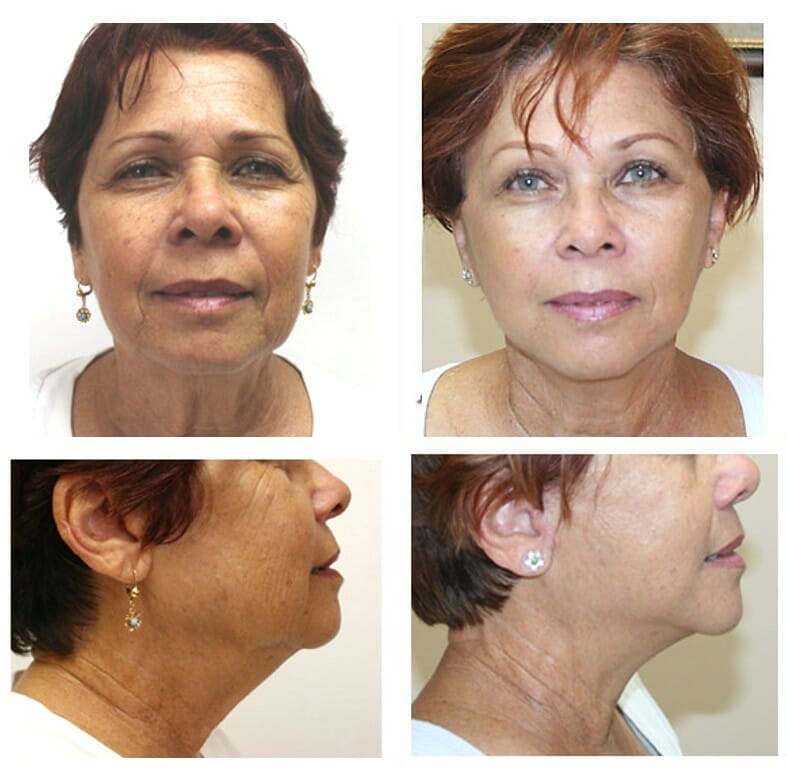 facelift before and after fort lauderdale