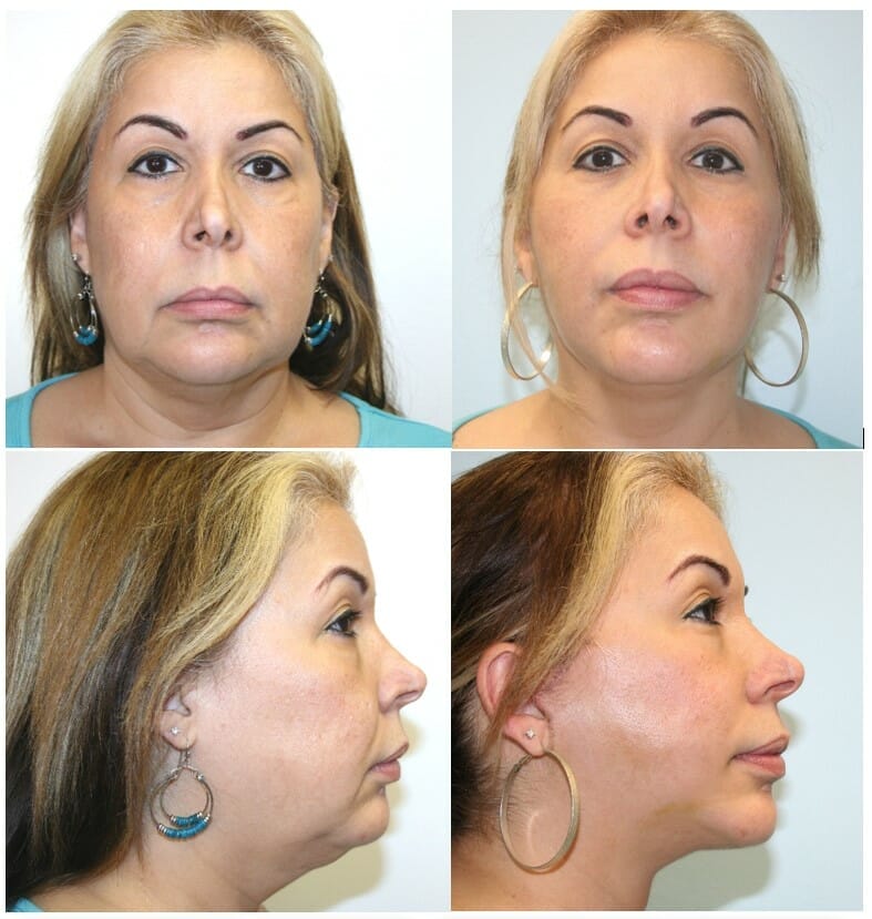 Facelift212 facelift before and after fort lauderdale