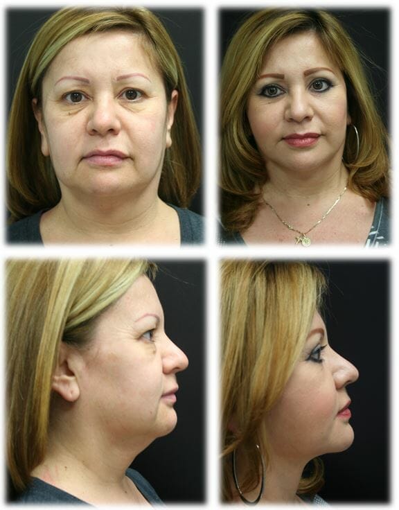 facelift before and after fort lauderdale