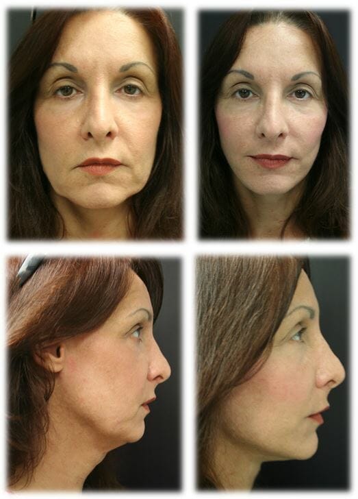 facelift before and after fort lauderdale