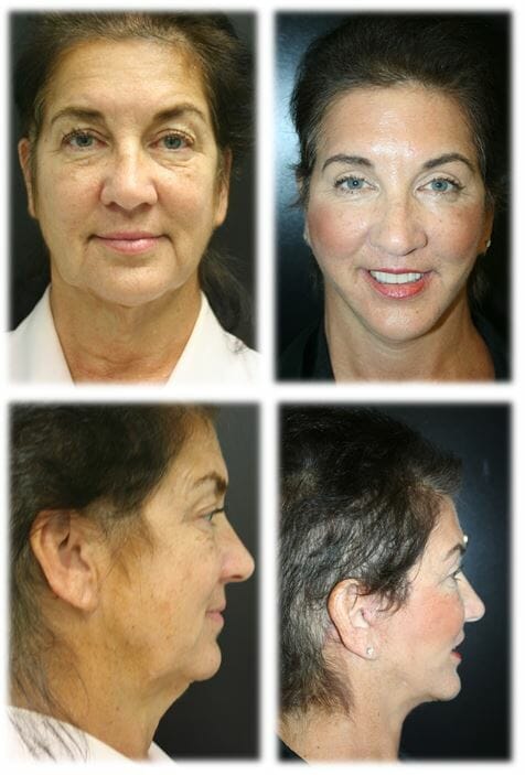 Facelift26 facelift before and after fort lauderdale
